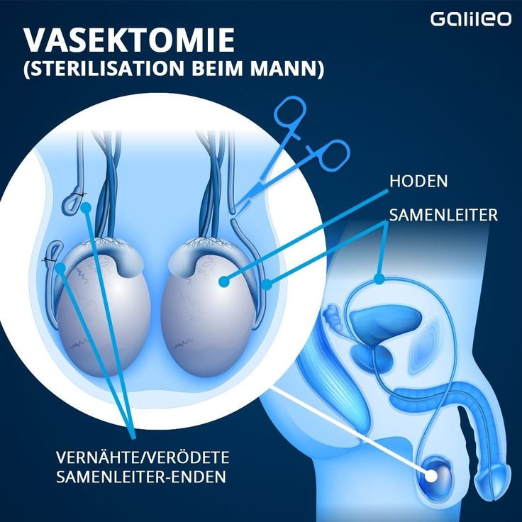 VASEKTOMI ANTARA INOVASI DAN KONTROVERSI